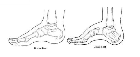 Type of Feet
